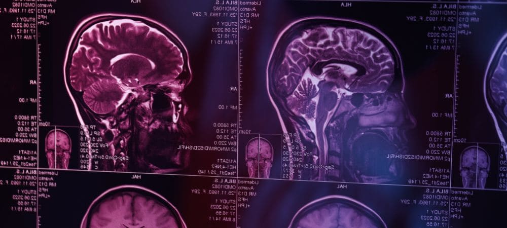 psilocibina en el cerebro